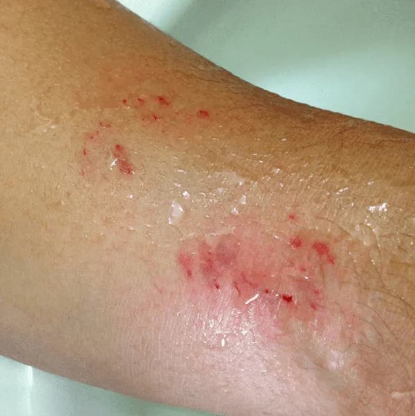 Snake bite